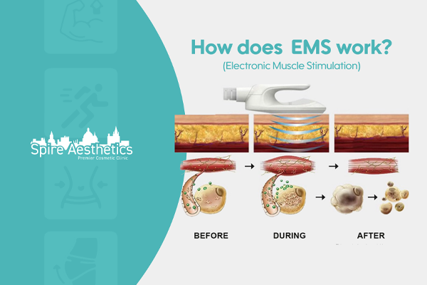 EMS treatment for post pregnancy weight loss treatment Dudley