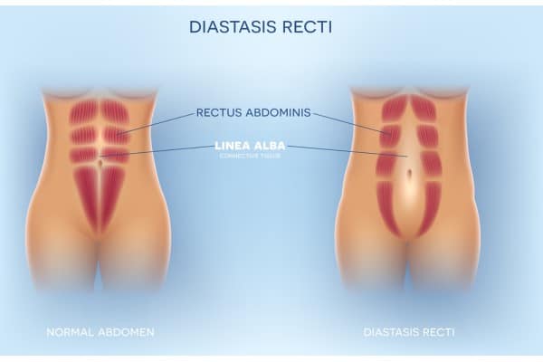 What Non-Surgical Options Are Available for Diastasis Recti Dudley?