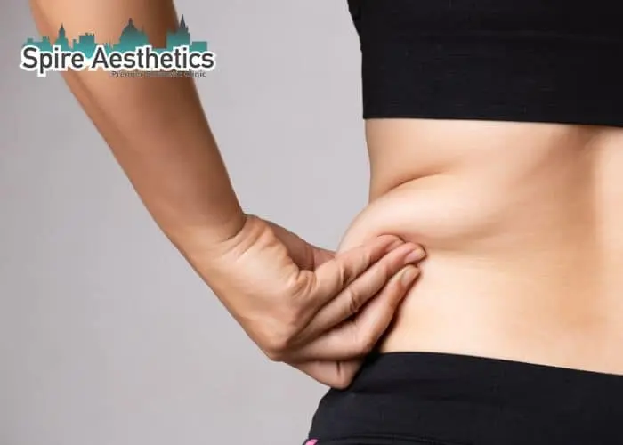 Image of woman pinching fat on their hips Dudley. Fat Freezing treatment