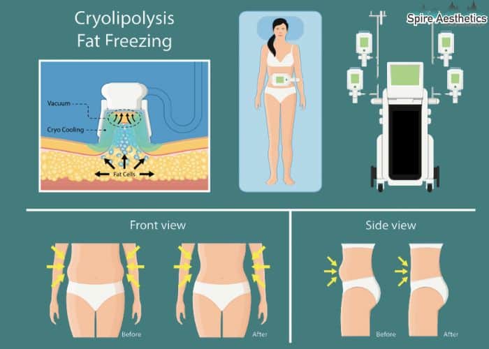 Image of diet and fat freezing combined for best results for Spire Aesthetics Dudley