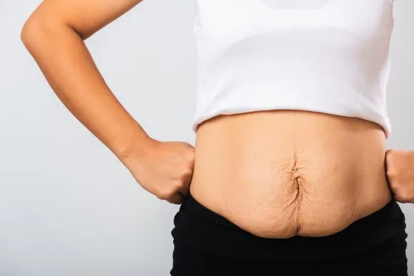 Image of a woman's stomach after weight loss with sagging skin following a gastric band Dudley