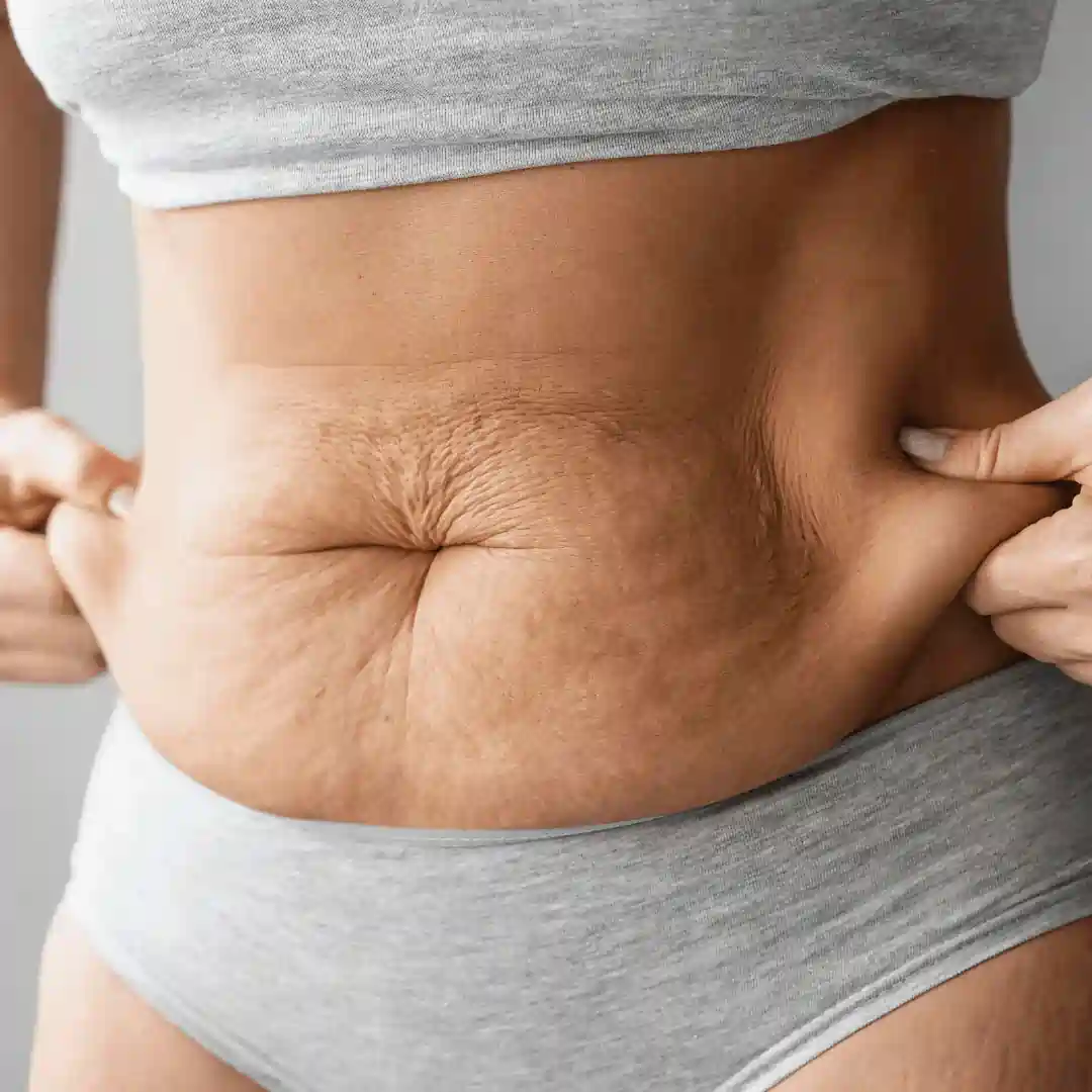 Is It Normal to Have Loose Skin After Pregnancy Dudley?