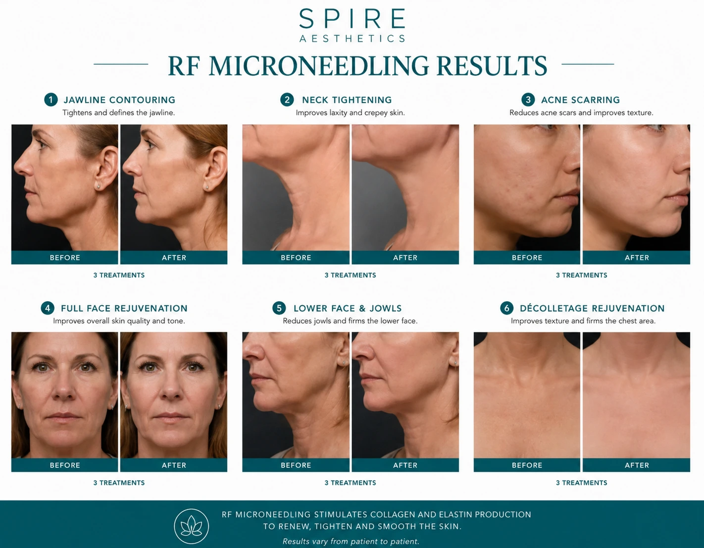 RF Microneedling Skin tightening Dudley results