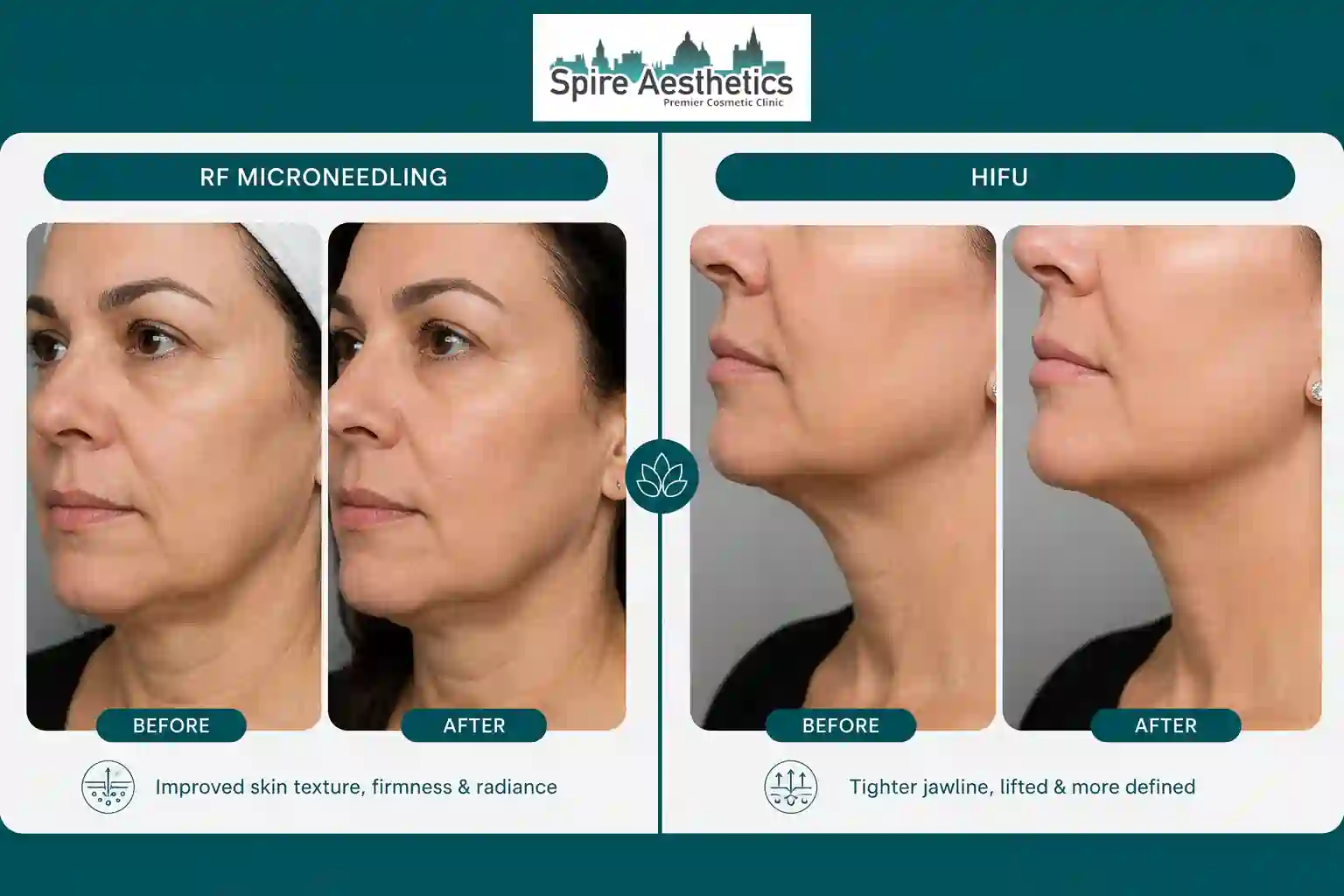 Can RF Microneedling and HIFU Be Combined Dudley?