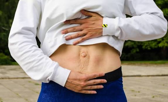When Could Diastasis Recti Be the Missing Piece of the Puzzle Dudley?