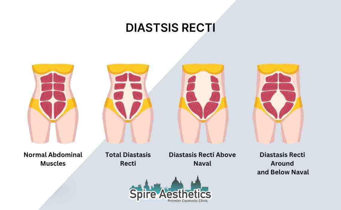 Is Non-Surgical Diastasis Recti Treatment Right for You? Common Concerns Answered Dudley